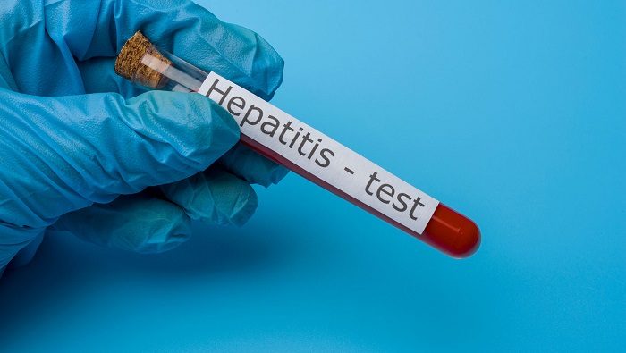 Hepatitis aguda grave en Jalisco